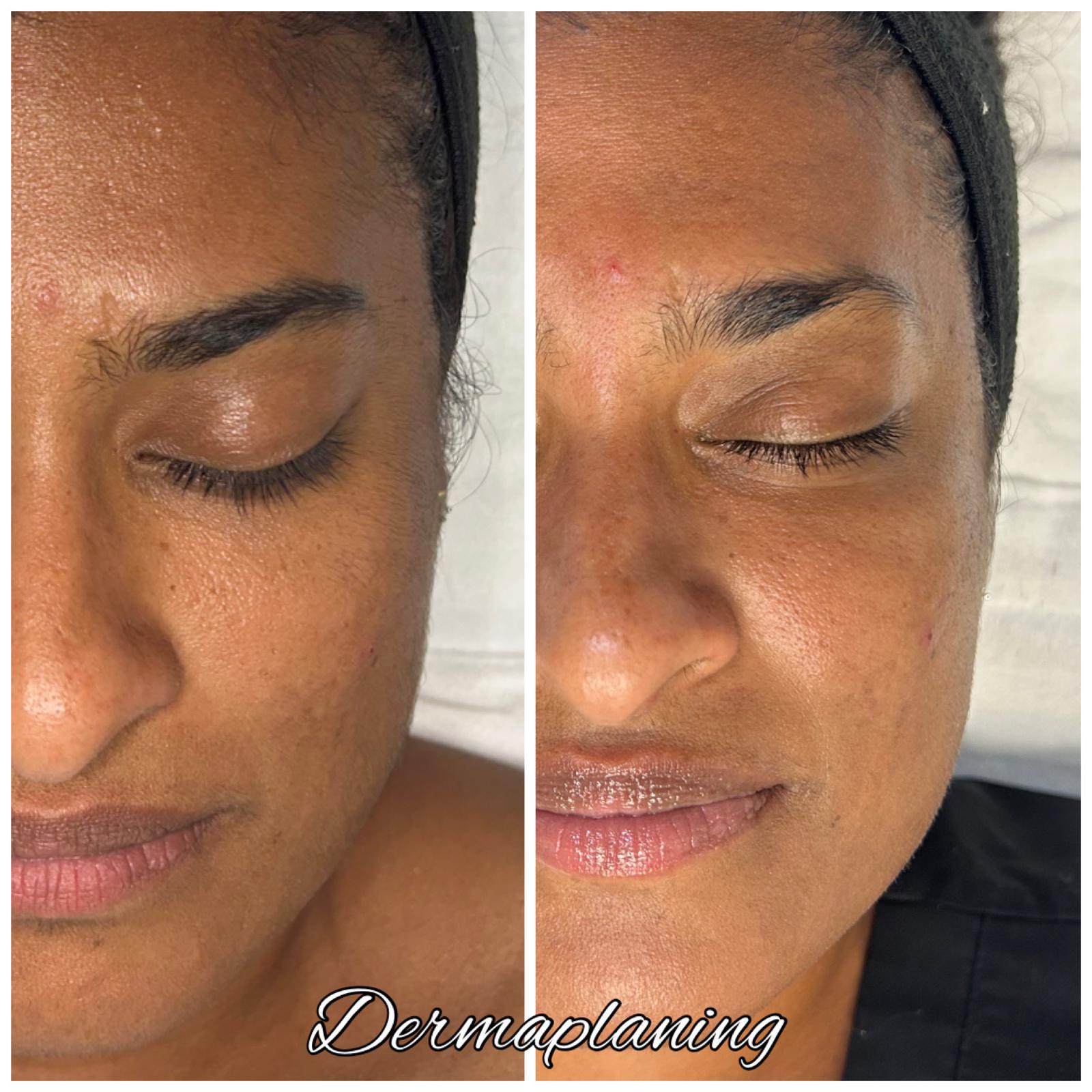 dermaplaning-before -and-after