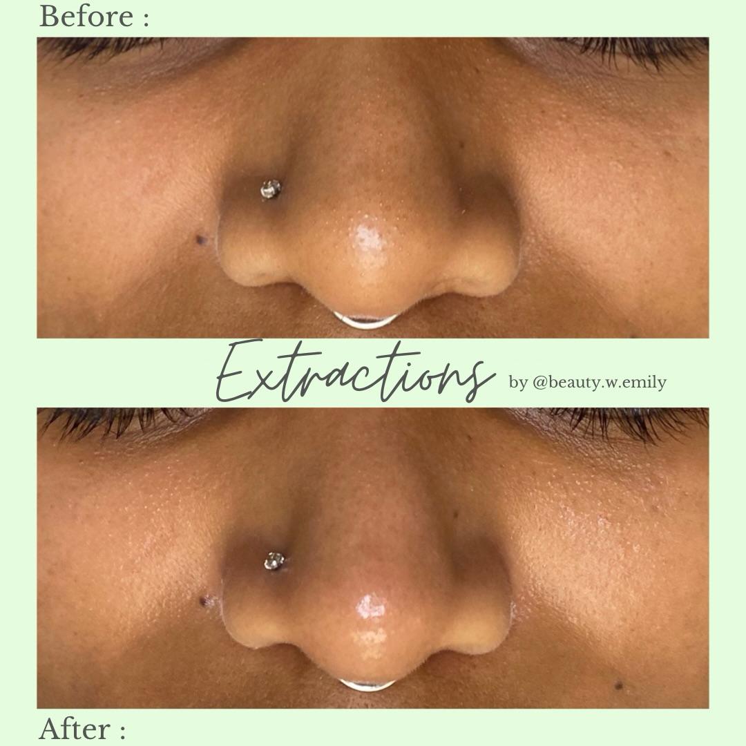Before and After Facial Extractions